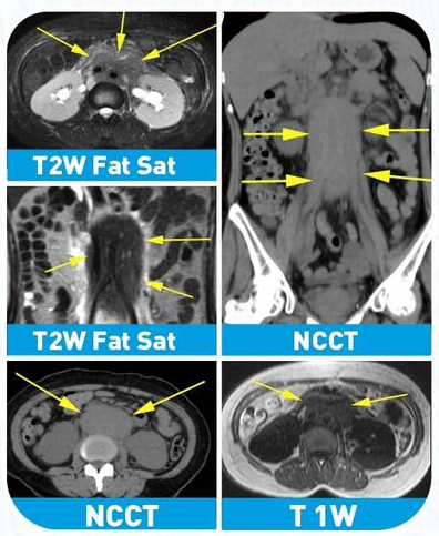 Retro Peritoneal Fibrosis