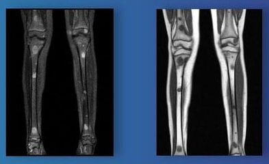 Rosai Dorfman Disease