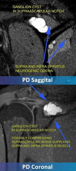 Supra Scapular Nerve Entrapment - Neuropathy By Ganglion Cyst