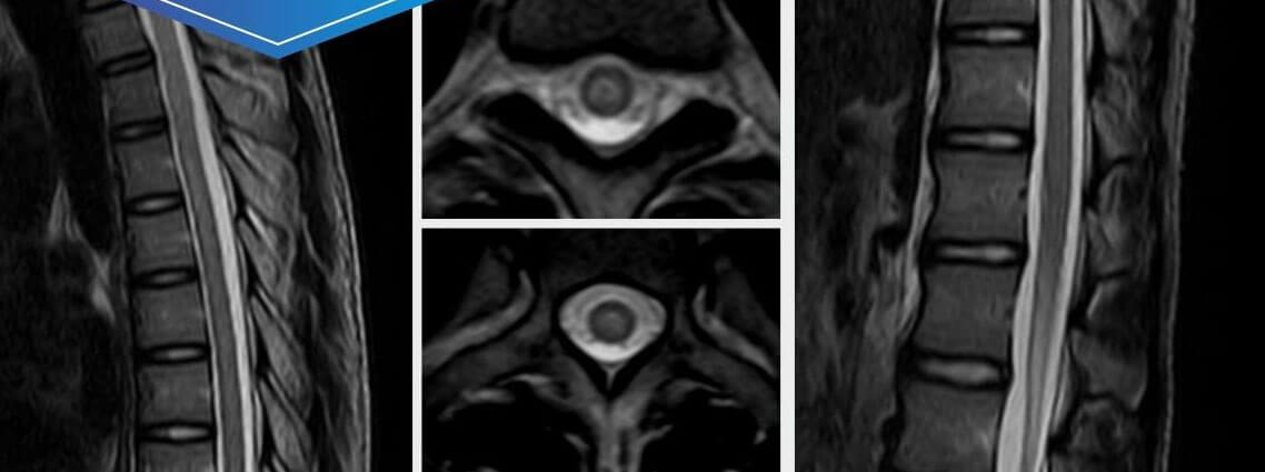 Post Dengue (Viral) ADEM/ Transverse Myelitis