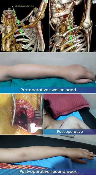 Venous Thoracic Outlet Syndrome (McCleery Syndrome)